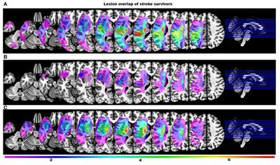 The relationship between motor pathway damage and flexion-extension patterns of muscle co-excitation during walking